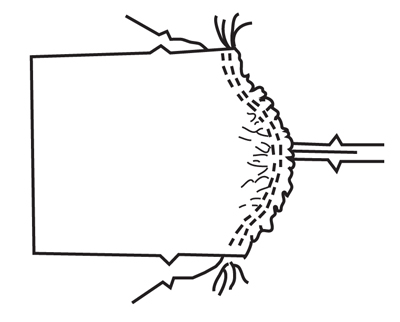 Illustration demonstrating step: Ease-stitch the sleeve cap according to pattern instructions.