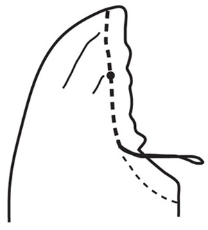 To ease the fullness, pull the bobbin thread(s) until the sleeve cap fits the armhole. Distribute the fullness, evenly matching the notches and dots of the sleeve to those of the armhole. There should not be any easing in the top 1 inch (2.5 cm) of the sleeve cap.