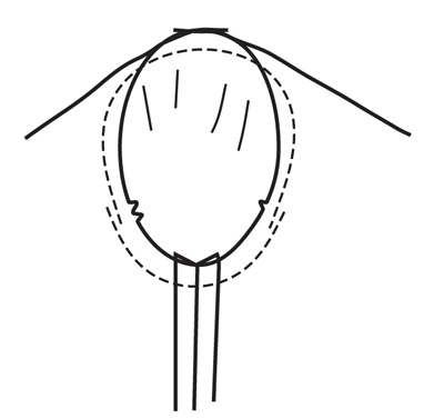 Sew sleeve underarm seam on 5/8 inch (1.5 cm) from notch to notch, overlapping the stitching about 1 inch (2.5 cm) at notches.