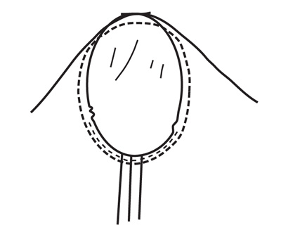 Trim the underarm seam allowance from notch to notch to reduce bulkiness. Stitch again on 4/8 inch (1 cm). Do not clip seam allowance.
