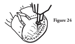 Fig. 24: Fold the placket bindings or facing over the ends of the band and pin. 