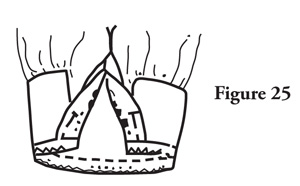 Fig. 25: Sew on 5/8 in. with straight stitch. Zigzag stitch the seam 1/4 in. from seamline and trim seam allowance close to stitching. 