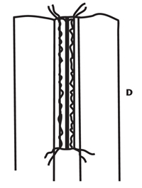 Illustration demonstrating step: Press. Remove tape and basting stitches (D).