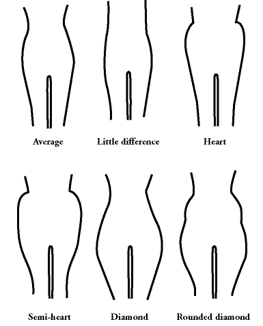 Illustration showing the different hip shapes
