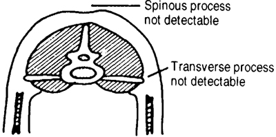 Figure 9. Body Condition Five. Sheep are extremely fat with the excess detectable over the shoulder, backbone, rump, and fore rib. Excess fat deposits in brisket, flank, and tail head regions lack firmness. Sheep appear uncomfortable and reluctant to move about. Quality fleeces are generally found.