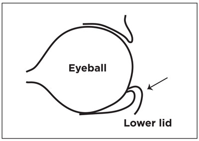Illustration of inverted eyelid.
