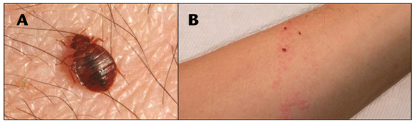 Fotos de A, Chinche de cama alimentándose sobre la piel de una persona; B, ronchas causadas por la picadura de  ninfas de chinches de cama 