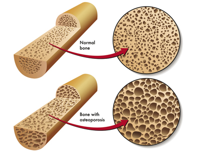 Fig. 1 Illustration of  a comparison of healthy bones (top) and bones with mineral loss due to osteoporosis (bottom)