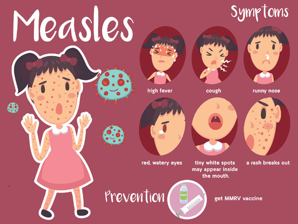 Fig. 02: Infographic describing the symptoms of measles.