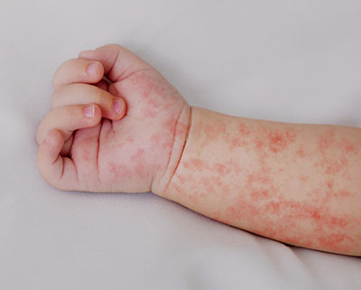Fotografía del brazo de un bebé cubierto de manchas rojas.